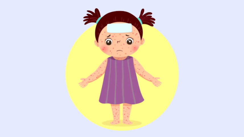 Measles