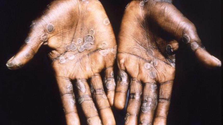monkeypox.jpg