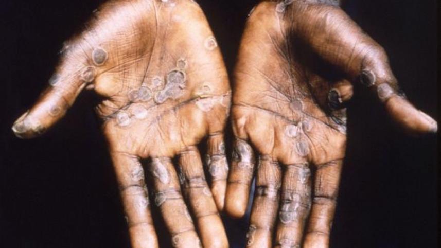 monkeypox.jpg