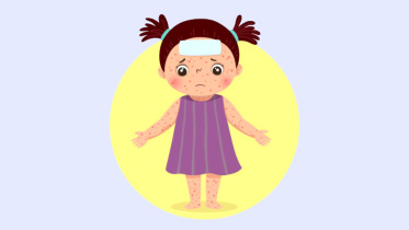 Measles