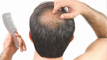 hair_loss_0.jpg