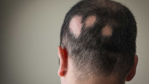 alopecia